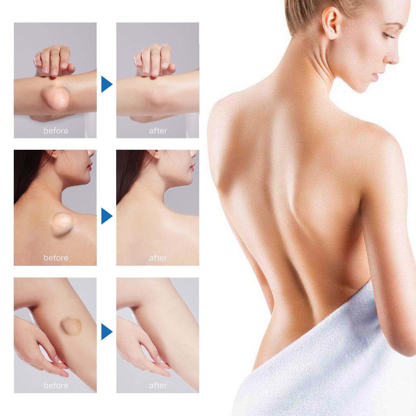 Lipoma Cream – Creme para Lipomas