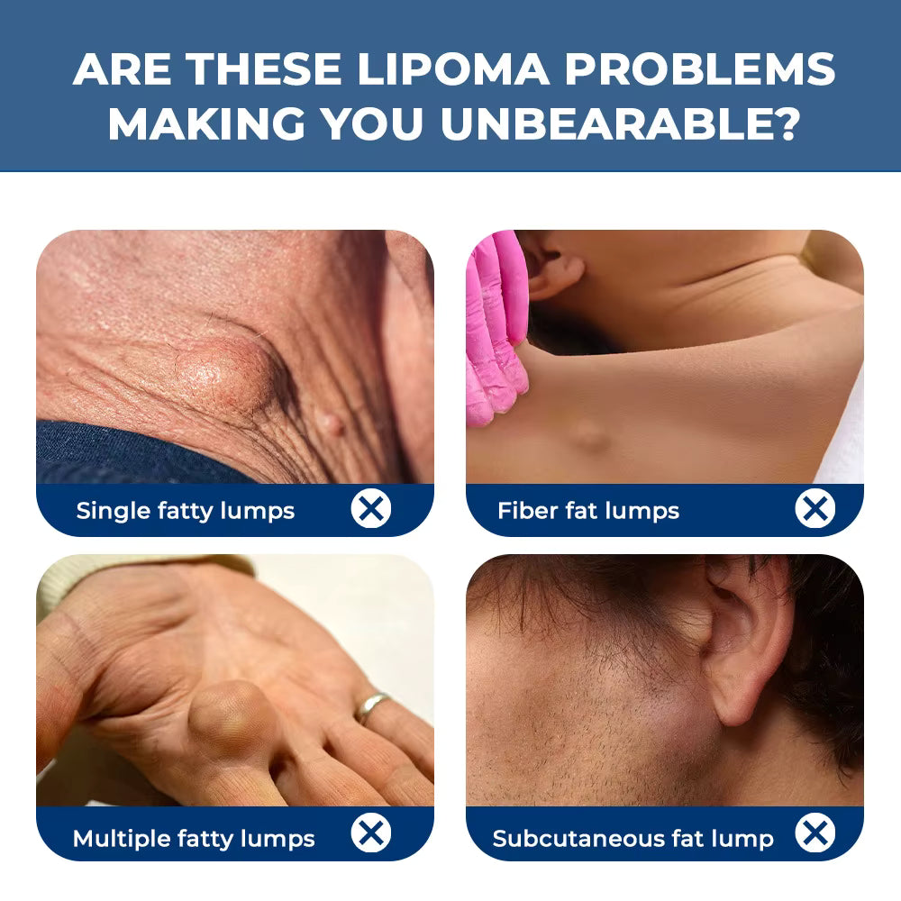 Lipoma Cream – Creme para Lipomas